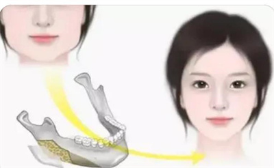 瓜子脸整形案例分享!大饼脸变脸变瓜子脸!术前攻略必看!