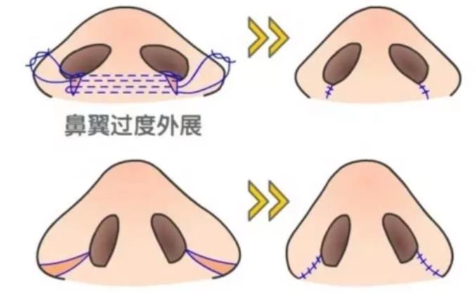 鼻尖