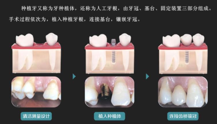 牙齿种植