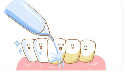 洗牙齿有什么好处和坏处？适用哪些人群？术后有注意事项？
