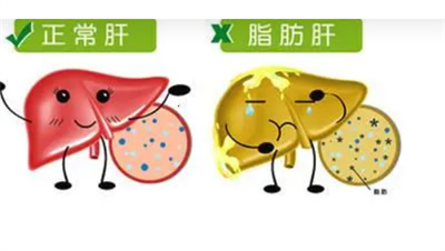 脂肪肝吃什么才能减掉肝脏上的脂肪？如何避免脂肪肝产生？
