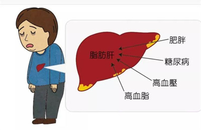 脂肪肝吃什么才能减掉肝脏上的脂肪？如何避免脂肪肝产生？