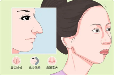 怎么改良鹰钩鼻子?做鹰钩鼻矫正手术术前应该做哪些准备?