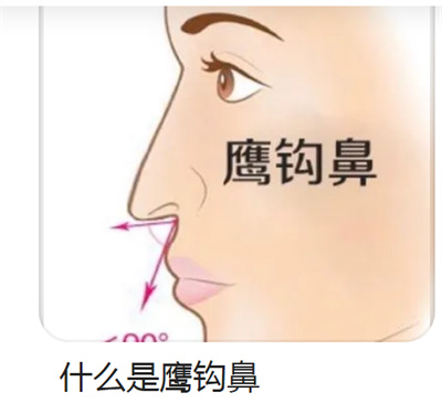 怎么改良鹰钩鼻子?做鹰钩鼻矫正手术术前应该做哪些准备?