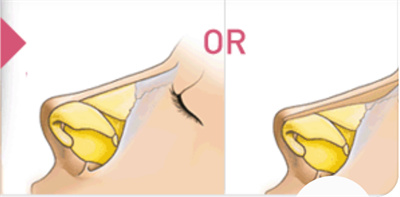 怎么改良鹰钩鼻子?做鹰钩鼻矫正手术术前应该做哪些准备？