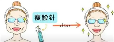 注射瘦脸多久可以看出果?有副作用吗?注射术后注意事项!