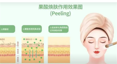芯丝翠果酸换肤果怎么样?原理是什么?术后怎么护理肌肤?