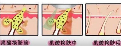 芯丝翠果酸换肤果怎么样?原理是什么?术后怎么护理肌肤?