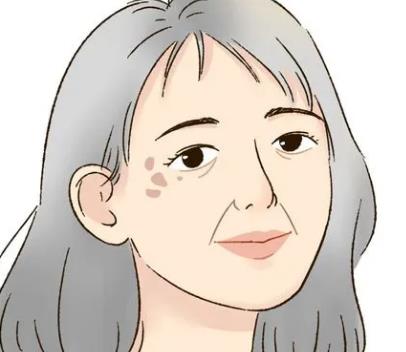 老年斑消除好的方法!老年斑是怎么形成的？如何避免？