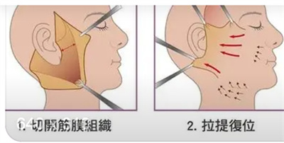 王菲现拉皮后遗症！今非昔比～是永远的女神！抗衰老天花板！