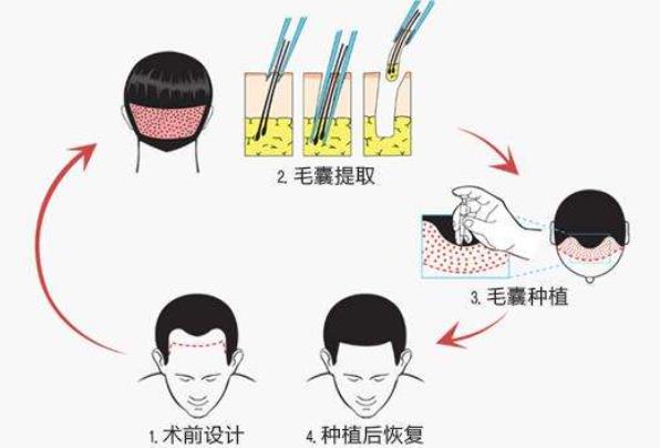 头发如何种植？植发一般需要多少钱？影响因素介绍