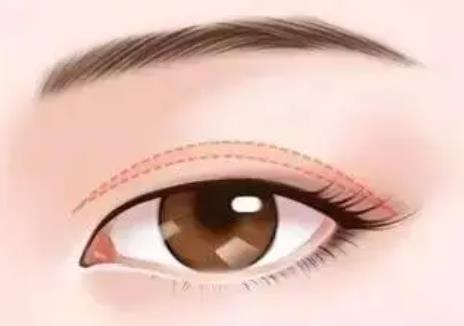 双眼皮恢复一到七天图曝光！做双眼皮后多久可以恢复？