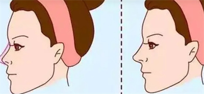 玻尿酸隆鼻一般价格是多少?受哪些因素影响?术后注意事项!