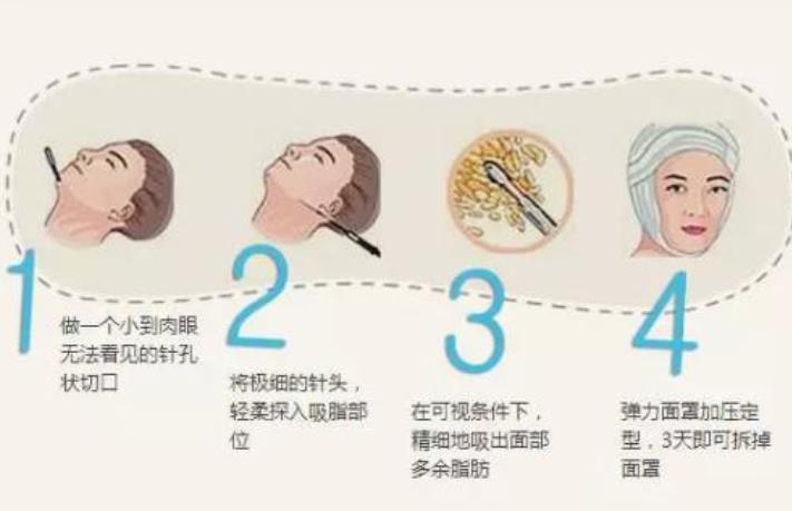 面部吸脂