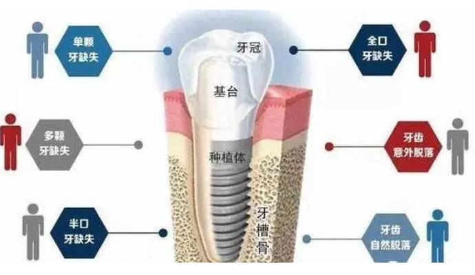 牙齿种植