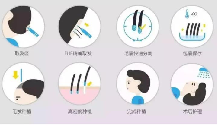 头发种植