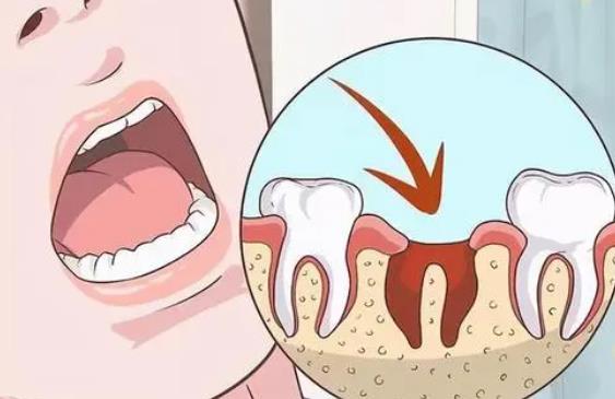 拔牙后的注意事项有哪些？拔完牙之后几天能恢复正常?