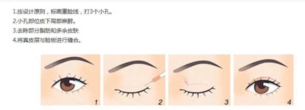韩式三点式双眼皮能维持多久？双眼皮操作原理是什么?
