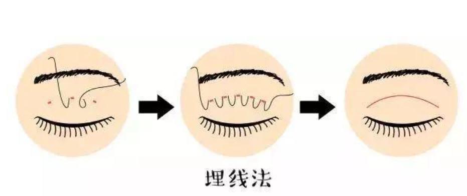 韩式三点式双眼皮能维持多久？双眼皮操作原理是什么?