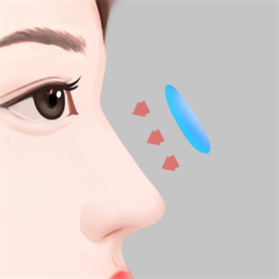 鼻部综合整形是什么？内附鼻子整形的原理和注意事项！