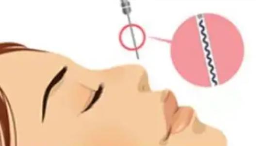 注射胶原蛋白隆鼻真人案例分享！来看看前后对比图吧