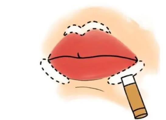 玻尿酸丰唇术整形案例图曝光!丰唇后恢复期注意事项有哪些?