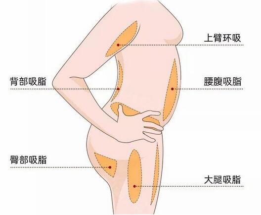 局部吸脂减肥创伤大不大?减肥后的注意事项有哪些?