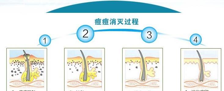 十滴水和甲硝唑凝胶能祛痘是真的吗?了解一下祛痘的有方法！