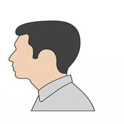 脱发严重怎么办如何控制脱发?脱发怎样预防?