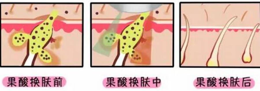 果酸换肤能去痘坑吗？做果酸在之后如何护理面部肌肤？