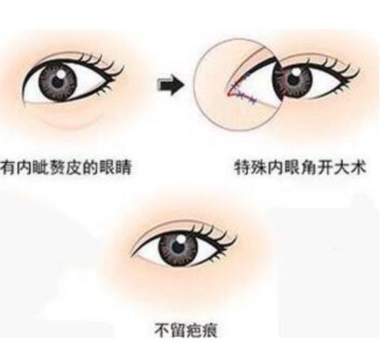 开眼角眼睛会变大吗？做开眼角手术需要注意哪些事情？