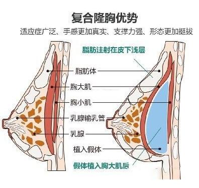 自体隆胸手术失败修复注意事项有哪些?这些细节你知道吗?