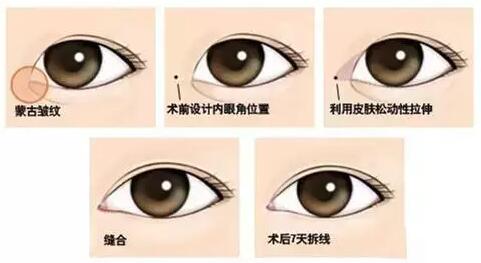 割双眼皮要开眼角吗？开眼角手术前要注意什么细节呢？