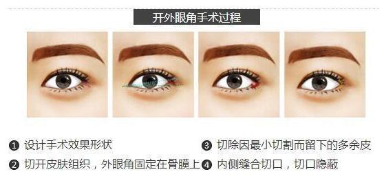 割双眼皮要开眼角吗？开眼角手术前要注意什么细节呢？