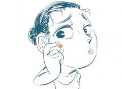 复光祛痘痘怎么样？术后恢复情况好不好？