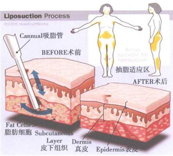 7天快速瘦腿有哪些方法？吸脂瘦腿手术怎么样？