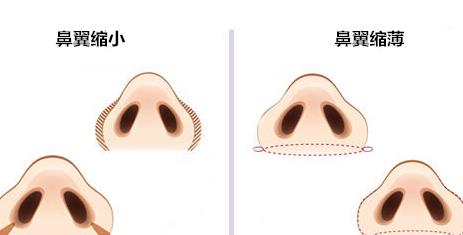 注射胶原蛋白隆鼻的价格是多少?注射隆鼻原理是什么?影响因素分享