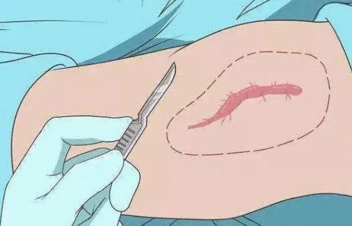 疤痕修复手术一般多少钱?手术方法有哪些?注意事项分享