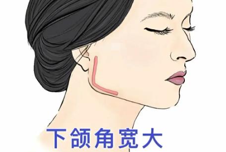 下颌骨整形价钱贵吗?做下颌角整形手术需要注意哪些事情?