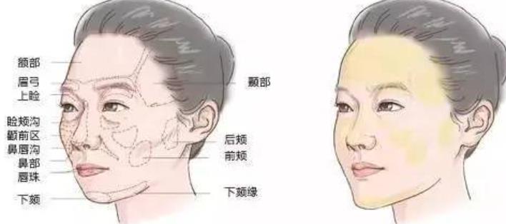 面部拉皮除皱整形好吗？做完之后多长时间能看见果？