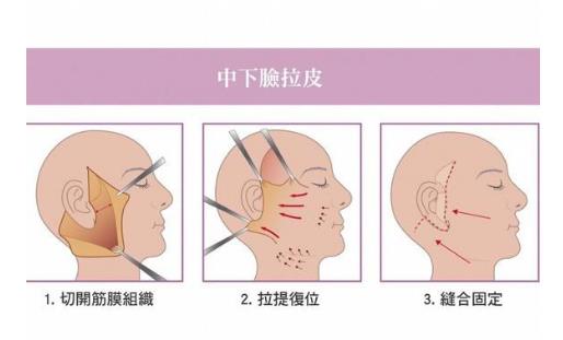 面部拉皮除皱整形好吗？做完之后多长时间能看见果？