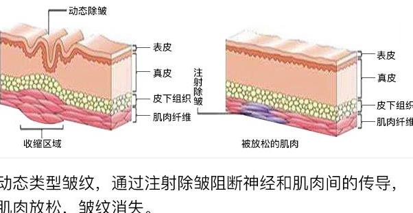 北京基恩医院医疗美容院口碑好不好？杨俊医生实操面部除皱案例分享！