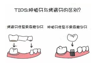 种植牙多少钱一颗呀？了解价格影响因素
