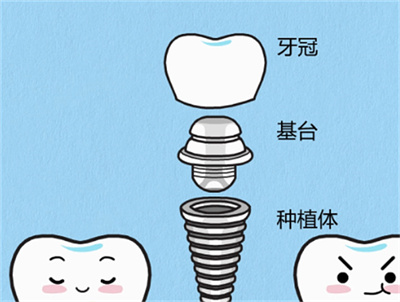 种一颗牙齿大概多少钱？影响牙齿费用多不多？