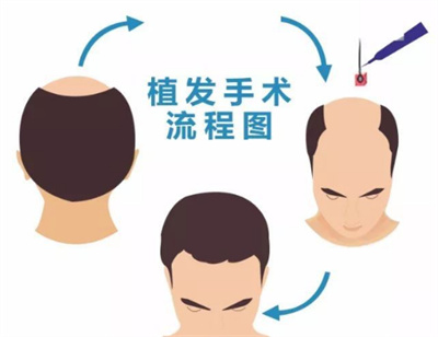 植发的危害有哪些？一探究竟了解植发攻略！