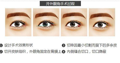 开眼角后遗症有哪些？普及几种开眼角类型？