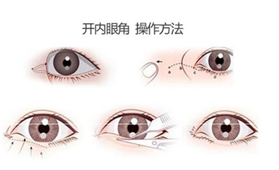 开眼角后遗症有哪些？普及几种开眼角类型？