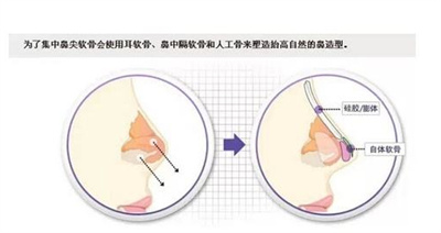 软骨隆鼻需多少钱?价格受到哪些影响呢!