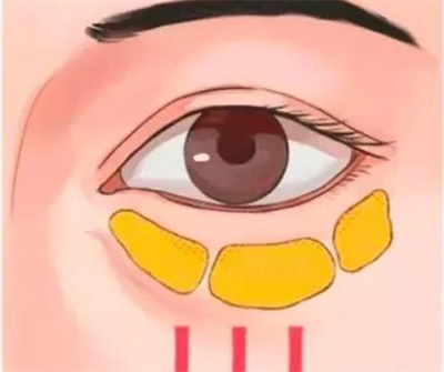 怎样去除眼袋，4点方法带来阐述？