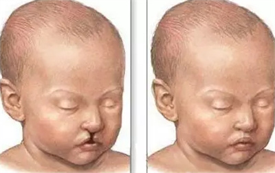 调节兔唇的费用是多少?具体价格来看介绍